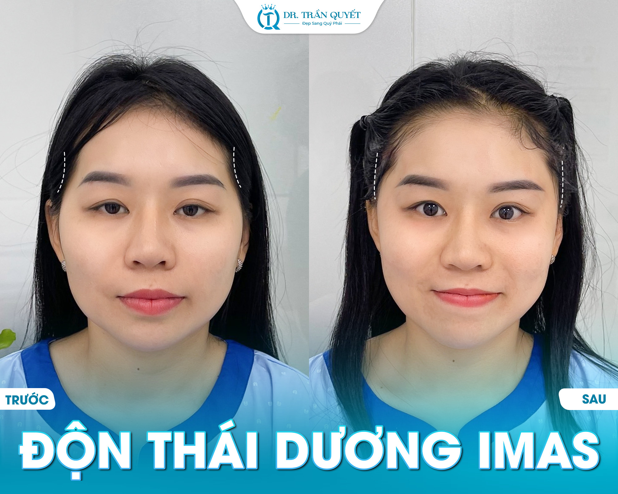 QUY TRÌNH ĐỘN THÁI DƯƠNG IMAS DIỄN RA NHƯ THẾ NÀO?