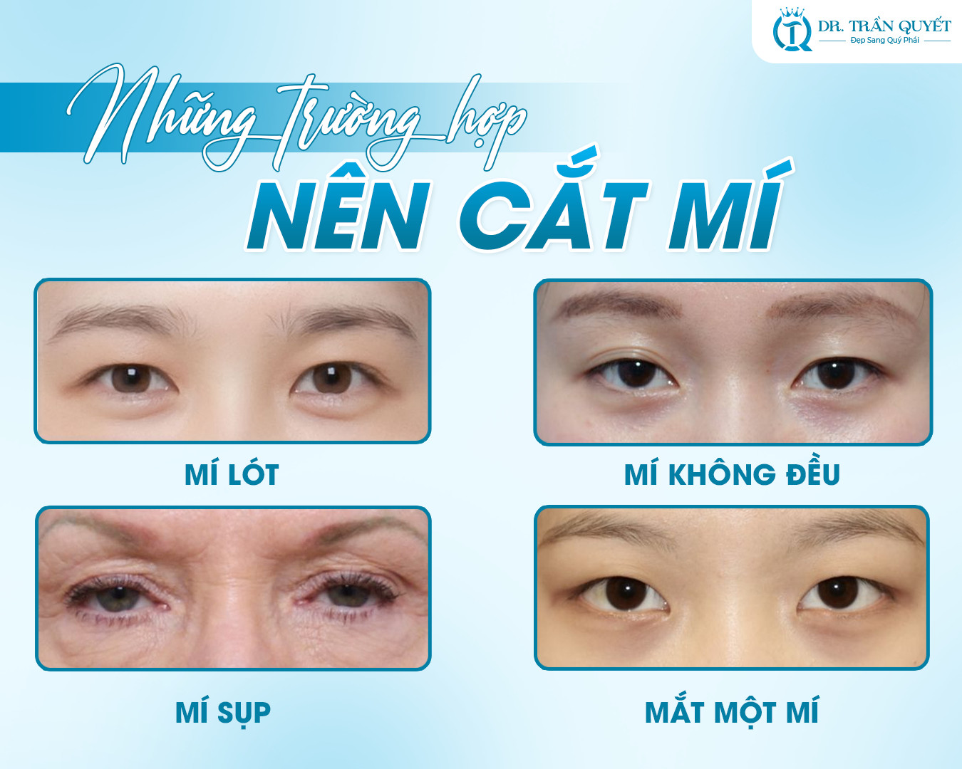 Những ai nên cắt mí?