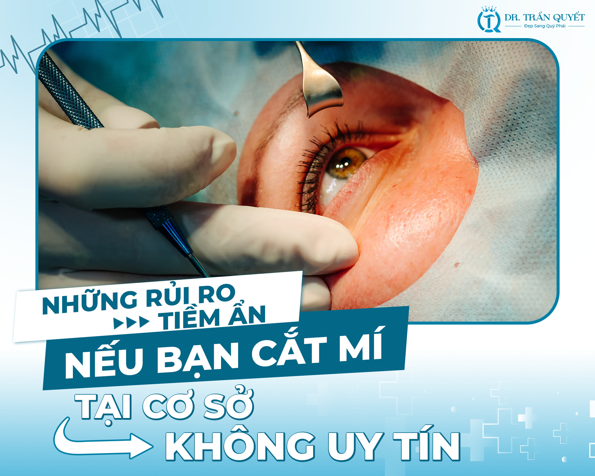 Những rủi ro tiềm ẩn nếu bạn cắt mí tại cơ sở không uy tín