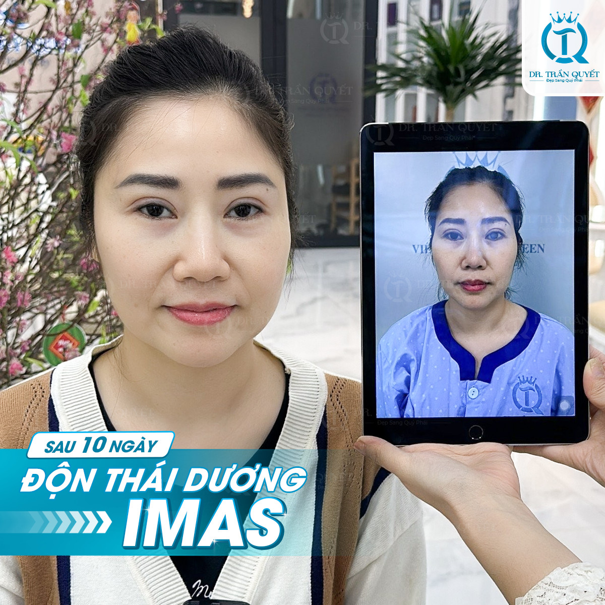 ĐỘN THÁI DƯƠNG IMAS